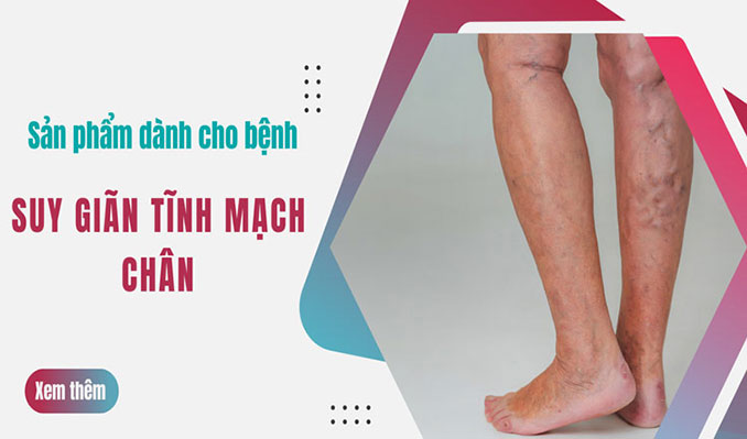 Bênh giãn tĩnh mạch