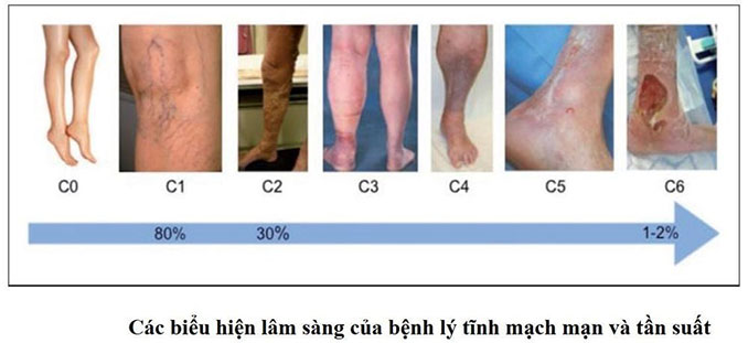 Các biểu hiện lâm sàng của bệnh lý tĩnh mạch mạn và tần suất Các biểu hiện lâm sàng của bệnh lý tĩnh mạch mạn và tần suất