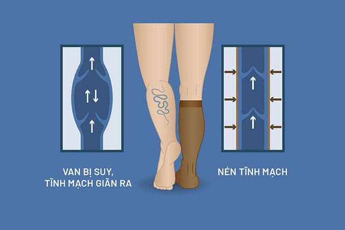Suy-Giãn-Tĩnh-Mạch-Enzyme-Enbio