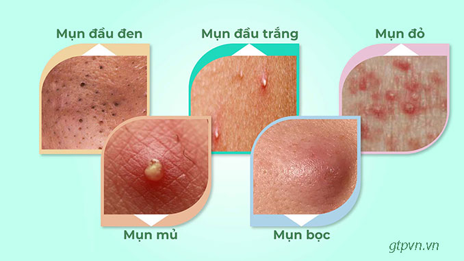 Nguyên nhân mụn lưng và cách điều trị hiệu quả tại nhà